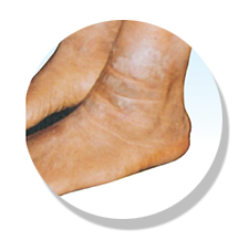 dryskin after