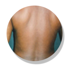 psoriasis-after
