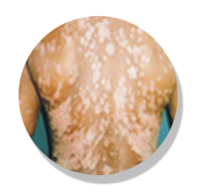 psoriasis-before