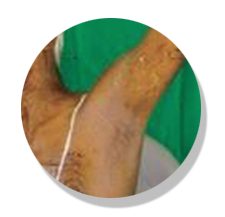vitiligo after
