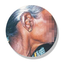 psoriasis-after