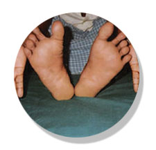 psoriasis-after