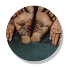 psoriasis-before