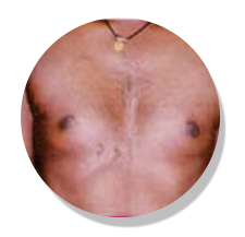 psorolin ointment after