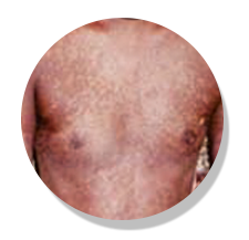 psorolin ointment before